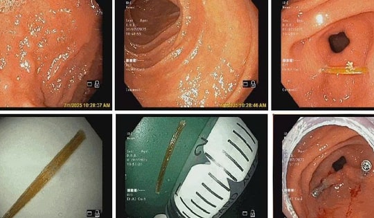 Bệnh nhi 8 tuổi bị tăm tre đâm xuyên thành dạ dày