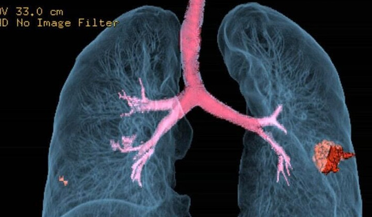 Người đàn ông 60 tuổi phát hiện ung thư phổi di căn từ dấu hiệu nhiều người Việt bỏ qua