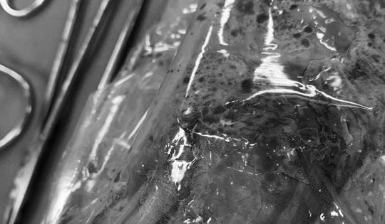 Mổ sinh, phát hiện u quái giống hình hài 1 thai nhi