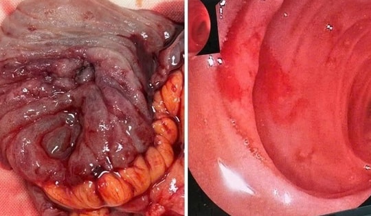 Người đàn ông suýt mất mạng do xuất huyết ruột non hiếm gặp