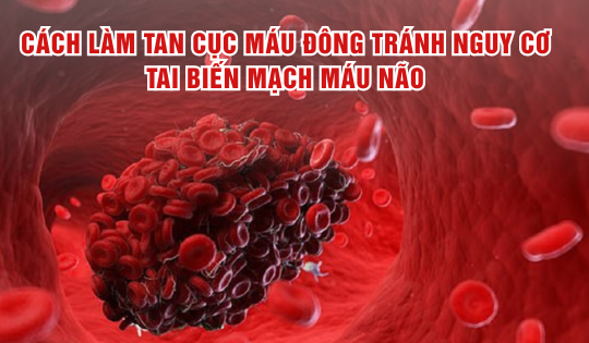 Cách hỗ trợ làm tan cục máu đông tránh nguy cơ tai biến mạch máu não