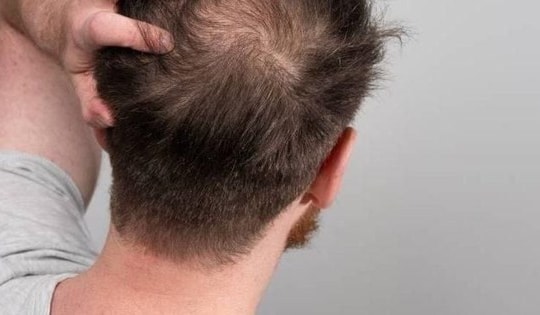 Dùng thuốc gây rụng tóc, chữa thế nào?