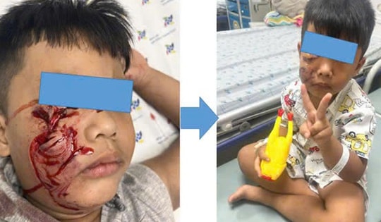 Bé trai 5 tuổi bị chó cắn rách mặt phải khâu 20 mũi