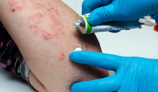 Thuốc điều trị bệnh vảy nến ở phụ nữ