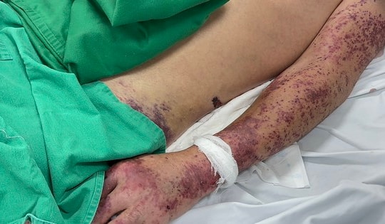 Đã có người tử vong vì nhiễm liên cầu lợn, Bộ Y tế khuyến cáo 6 cách phòng, chống bệnh