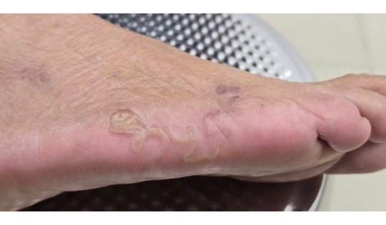 Làm vườn không mang bảo hộ, nữ bệnh nhân bị nhiễm giun móc chó mèo