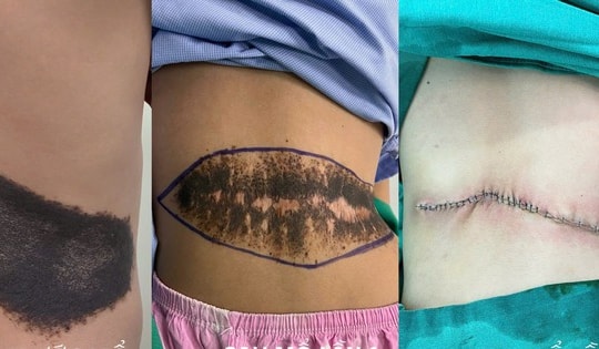 Phẫu thuật thành công khối u sắc tố khổng lồ ở lưng bé 8 tuổi
