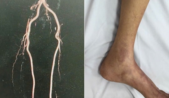 Thầy giáo suýt bị cưa 2 chân do tắc mạch chi từ lâu nhưng không có điều kiện đi chữa