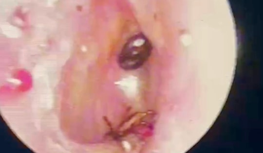 Năm con ve chó ký sinh nhiều ngày trong tai bé 9 tuổi