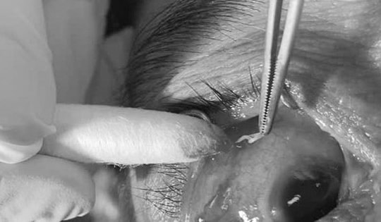 Suýt ngất khi phát hiện giun đũa dài 4cm nằm trong mắt