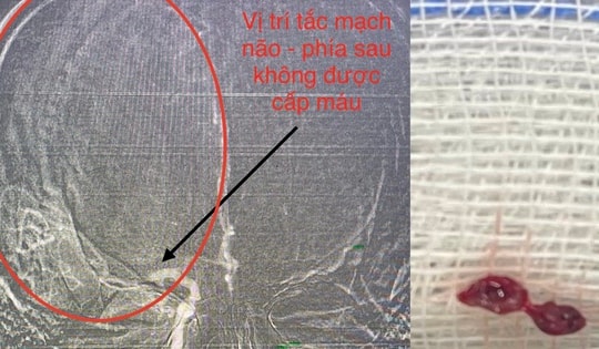 Liên tục tiếp nhận bệnh nhân đột quỵ, khuyến cáo của bác sĩ