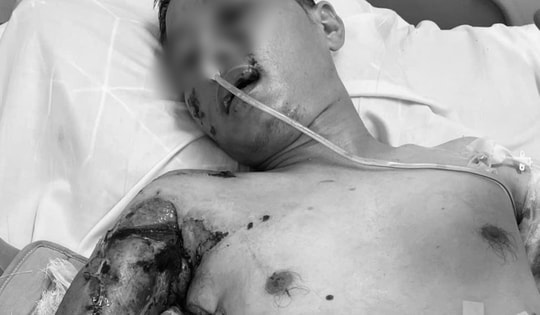 Đi xe máy mất lái, ngã vào đống sắt thép, nam thanh niên vỡ gan, đa chấn thương phải cấp cứu khẩn