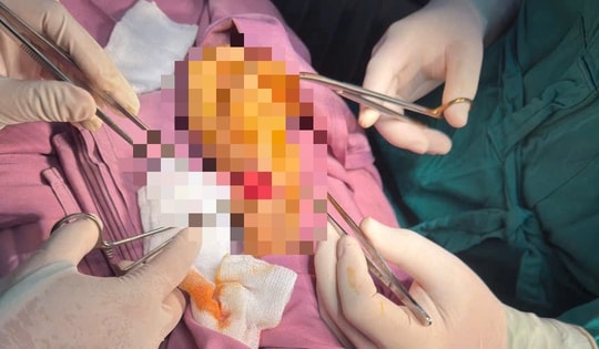 Cứu người phụ nữ bị đứt động mạch quay do dao cắt