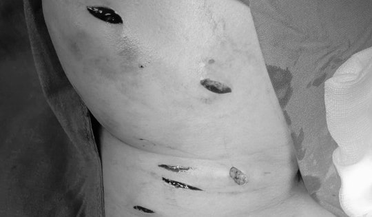 Cứu sống người phụ nữ bị đâm thủng tĩnh mạch cảnh