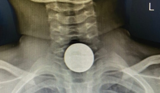 Bé trai 5 tuổi nhập viện cấp cứu vì đồng xu mắc ở thực quản