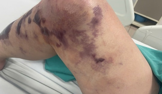 Bệnh nhân nguy kịch vì sốc nhiễm trùng sau khi lội biển bắt ngao