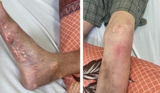 Tự ý mua thuốc của thầy lang để chữa gout, bệnh nhân bị suy tuyến thượng thận