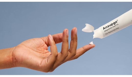 Kem dưỡng da không chứa steroid trị bệnh chàm tay