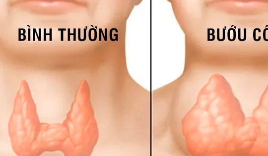 Thiếu i-ốt gây hại như thế nào?