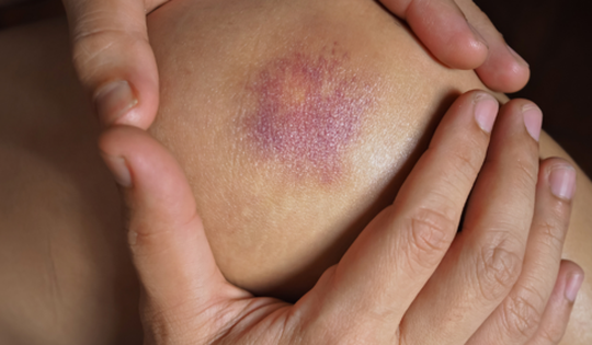 8 dấu hiệu cảnh báo thiếu hụt các vitamin, khoáng chất cụ thể