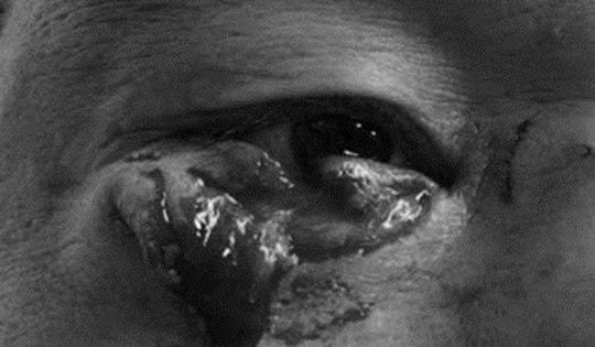 Phẫu thuật tạo hình thẩm mỹ cho người đàn ông ở Quảng Ninh bị chó cắn rách mi mắt