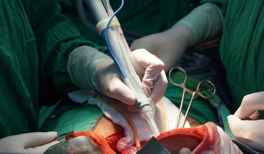 Người đàn ông mắc ung thư gan hồi sinh nhờ công nghệ hiện đại lần đầu đầu thực hiện ở Đồng bằng sông Cửu Long