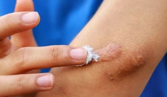 Bộ Y tế đình chỉ, thu hồi toàn quốc, yêu cầu tiêu huỷ 1 loại gel 'ngừa sẹo' do vi phạm 3 lỗi