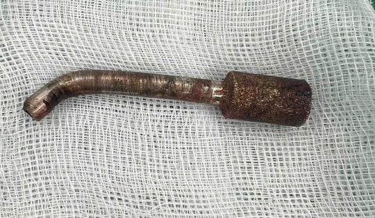 Đang khoan đá thanh niên bị mũi khoan ‘lưỡi câu’ xuyên hốc mũi