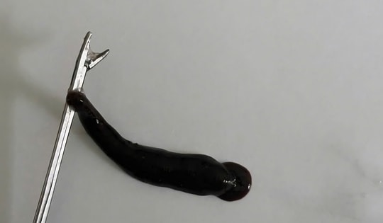 Đỉa dài 4cm ký sinh trong mũi bé trai suốt 10 ngày