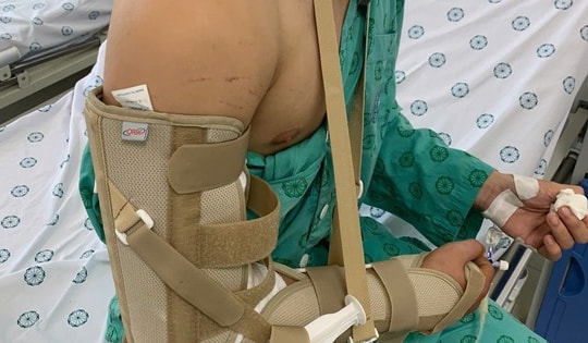 Chơi vật tay, nam thanh niên 18 tuổi bị gãy xương cánh tay