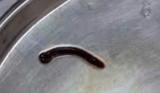 Phát hoảng đỉa rừng dài 4cm chui sâu trong hốc mũi bé gái 9 tuổi