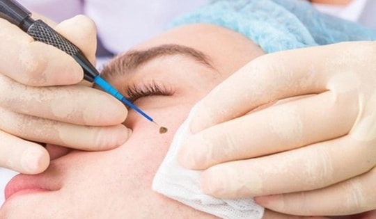 Đốt nốt ruồi nhiều lần, người đàn ông bất ngờ nhận tin dữ