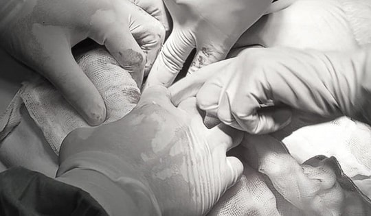 Dùng thuốc nam chữa u nang buồng trứng, người phụ nữ mang khối u nặng 9kg suốt 3 năm