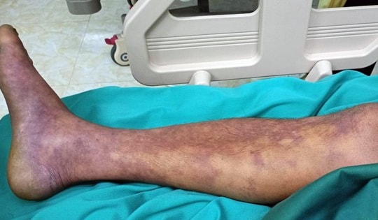 Ca nhiễm liên cầu lợn tăng ở một số nơi, cần biết các khuyến cáo phòng bệnh của Bộ Y tế