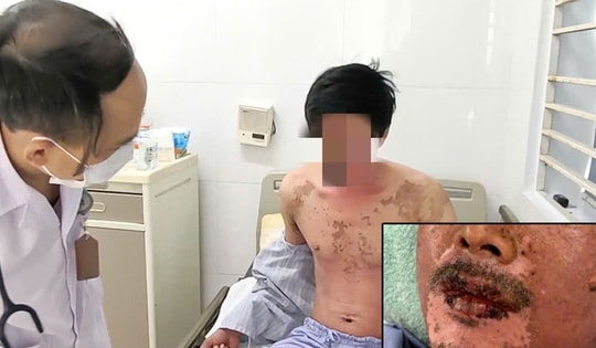 Nhiễm trùng huyết, suy gan, suy thận vì bị dị ứng silicon