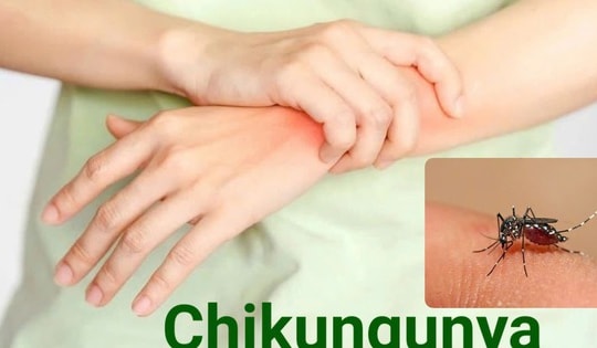 Bệnh Chikungunya: Nguyên nhân, triệu chứng, cách điều trị và phòng bệnh