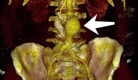 Cảnh giác với phình động mạch chủ khi bệnh không có biểu hiện rõ ràng