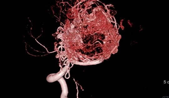 Cứu sống nam sinh 16 tuổi mắc dị dạng mạch máu não phức tạp