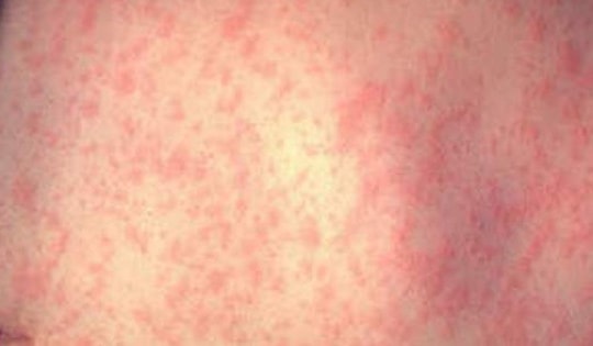 Số ca mắc bệnh sởi tại châu Mỹ tăng mạnh