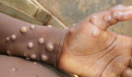 WHO khuyến cáo điều trị HIV sớm cho bệnh nhân đồng nhiễm Mpox