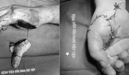 Cán bộ công an bị chém đứt rời bàn tay khi làm nhiệm vụ ở Hải Phòng đã được nối lại