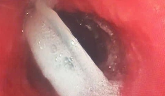 Hy hữu cụ ông nuốt cả nắp chai khi uống nước