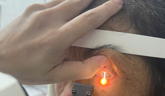 Bỏng mắt vì gội đầu bằng rượu ngâm hạt na