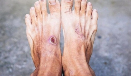 Bước đột phá mới trong điều trị bệnh tiểu đường tuýp 1