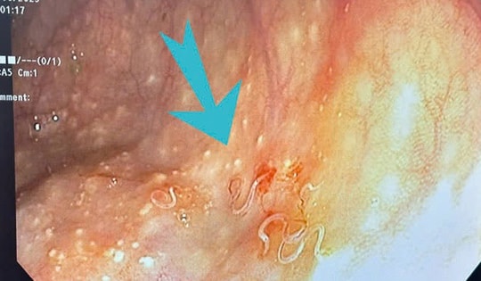 Phát hoảng vì đại tràng người phụ nữ 63 tuổi nhiều giun ký sinh