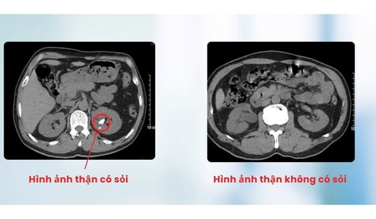 Tán sỏi qua da cho người đàn ông bị dị tật thận đôi cực hiếm