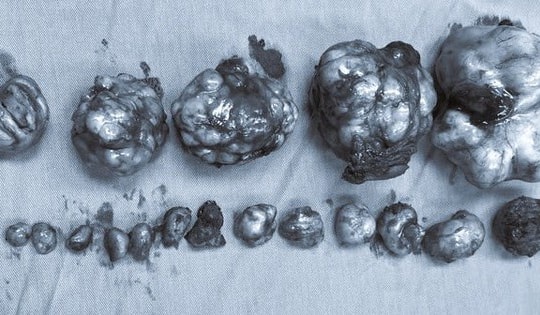 Người phụ nữ Quảng Ninh phát hiện 19 khối u xơ trong tử cung