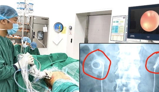 Biến chứng nguy hiểm vì 'quên' ống thông trong người 2 năm