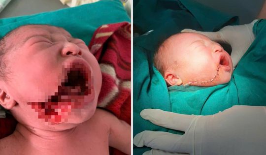 Những nỗ lực chăm sóc bà mẹ, trẻ em ở Lũng Cú và câu chuyện lay động cứu sống bé sơ sinh bị rạch một vết sâu vào má