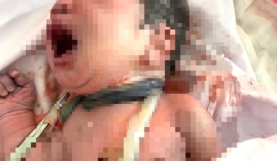 Hy hữu: Bé sơ sinh chào đời với dây rốn quấn 6 vòng quanh cổ